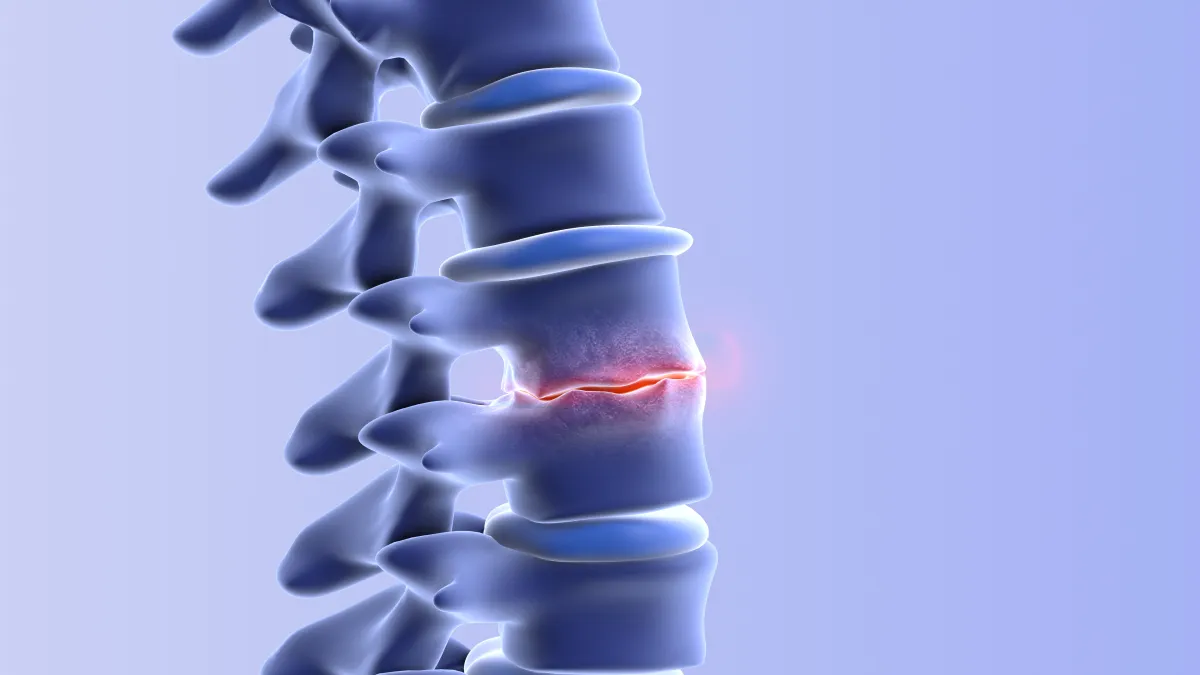 3D illustration of a fractured vertebra in the spine highlighted with a red glow on a blue background