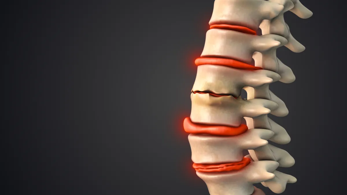 3D spine model with highlighted damaged and compressed vertebrae and discs, indicating back pain or injury.