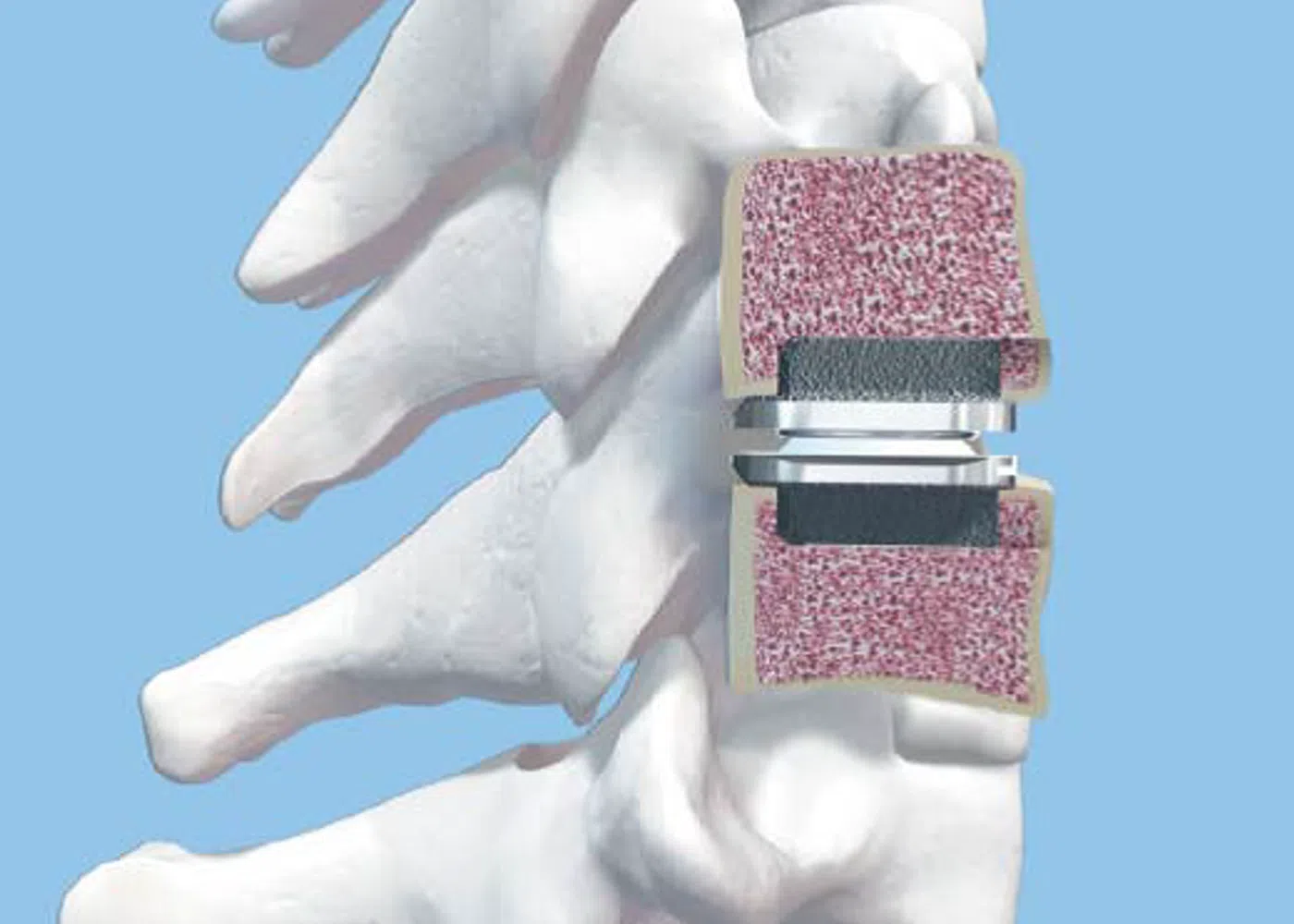 3D medical illustration of spinal vertebrae with an artificial disc implant for spinal disc replacement surgery.
