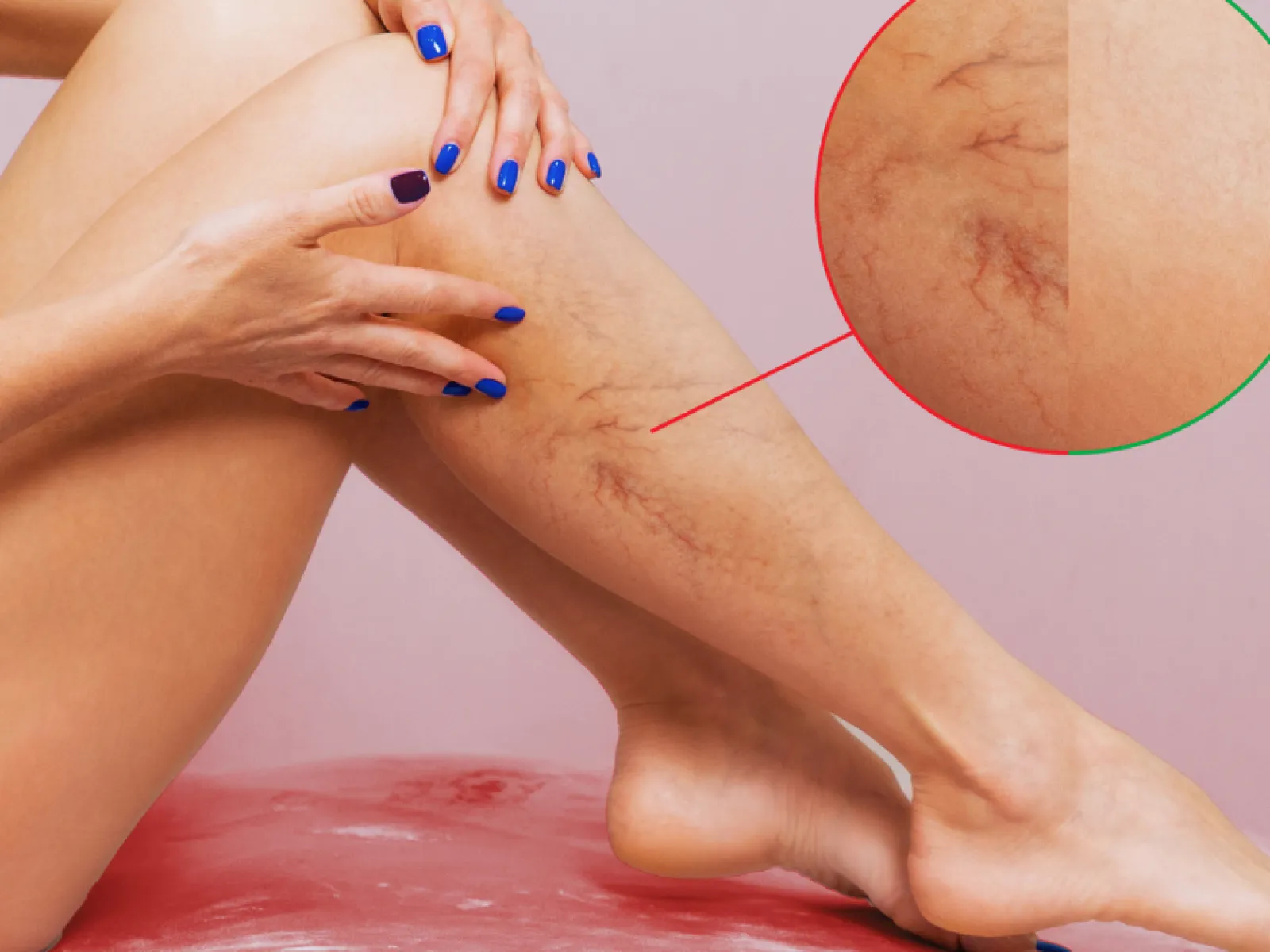Close-up of a woman's legs showing spider veins with a magnified inset highlighting the veins on skin.