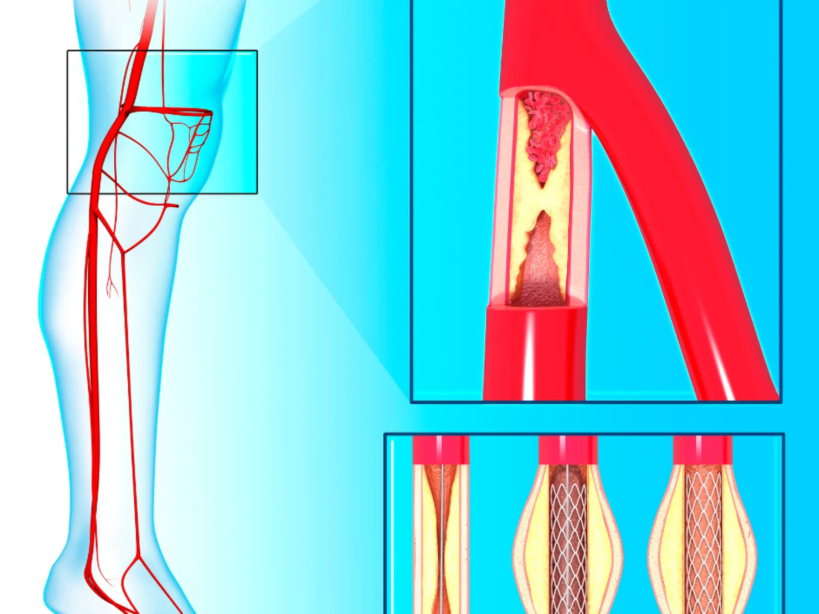 Illustration of leg arteries with a blocked artery and stent placement steps to restore blood flow