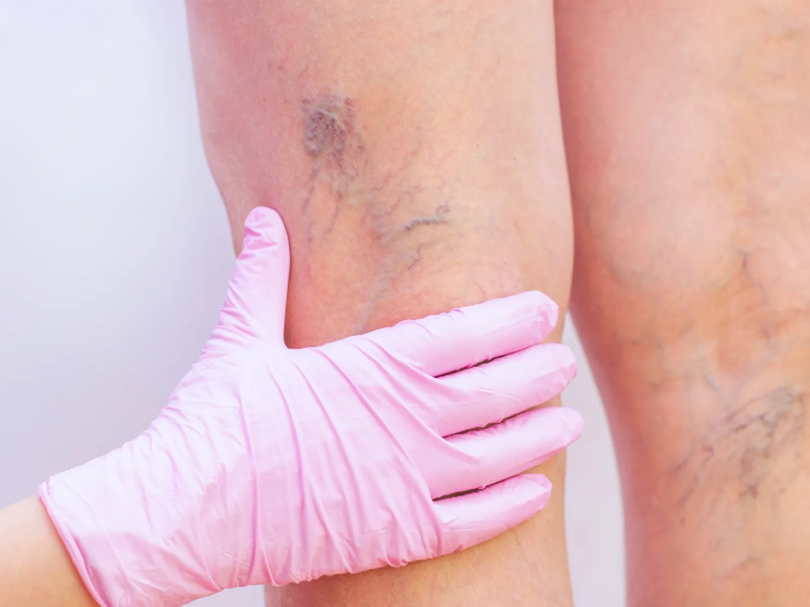 Doctor's hand in pink glove examining varicose veins on patient's leg against white background