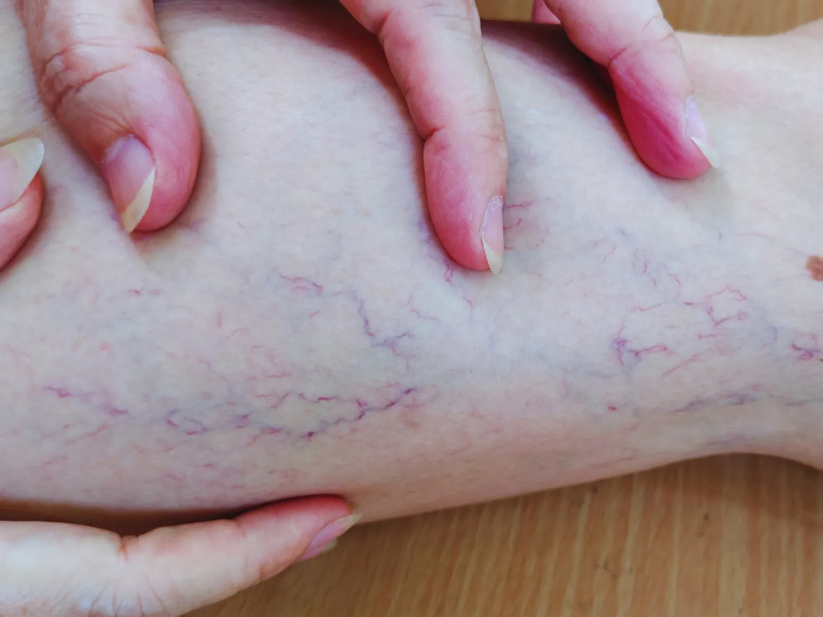 Close-up of a leg with visible varicose veins being examined by two hands on a wooden surface