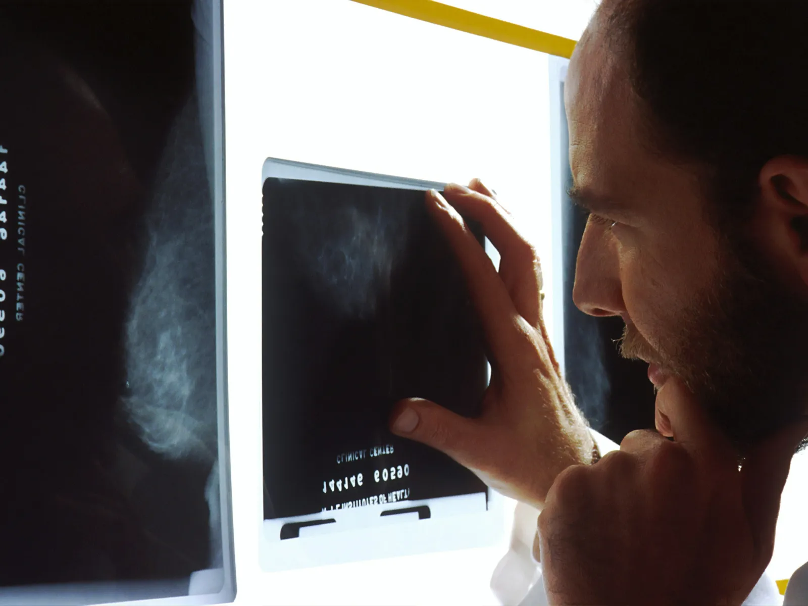 Man closely examining medical X-ray images on lightbox, analyzing details with focused expression.