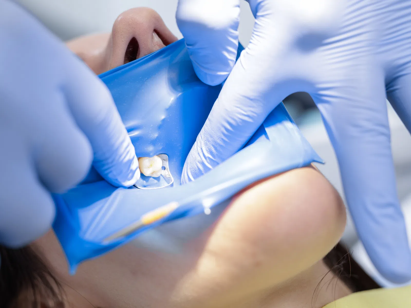 Dentist wearing blue gloves places dental dam around patient's tooth during procedure