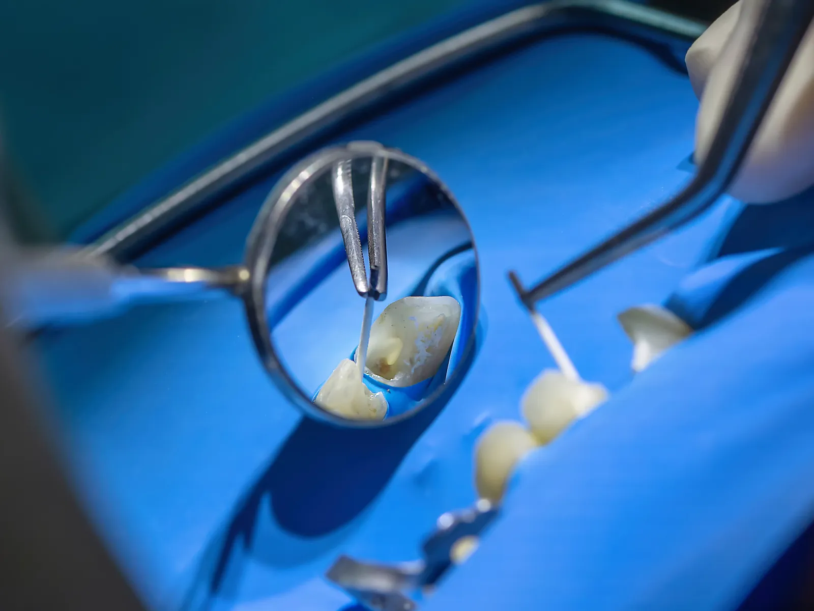 Close-up of dental tools and a mirror inspecting a tooth on a blue surgical drape during dental treatment.