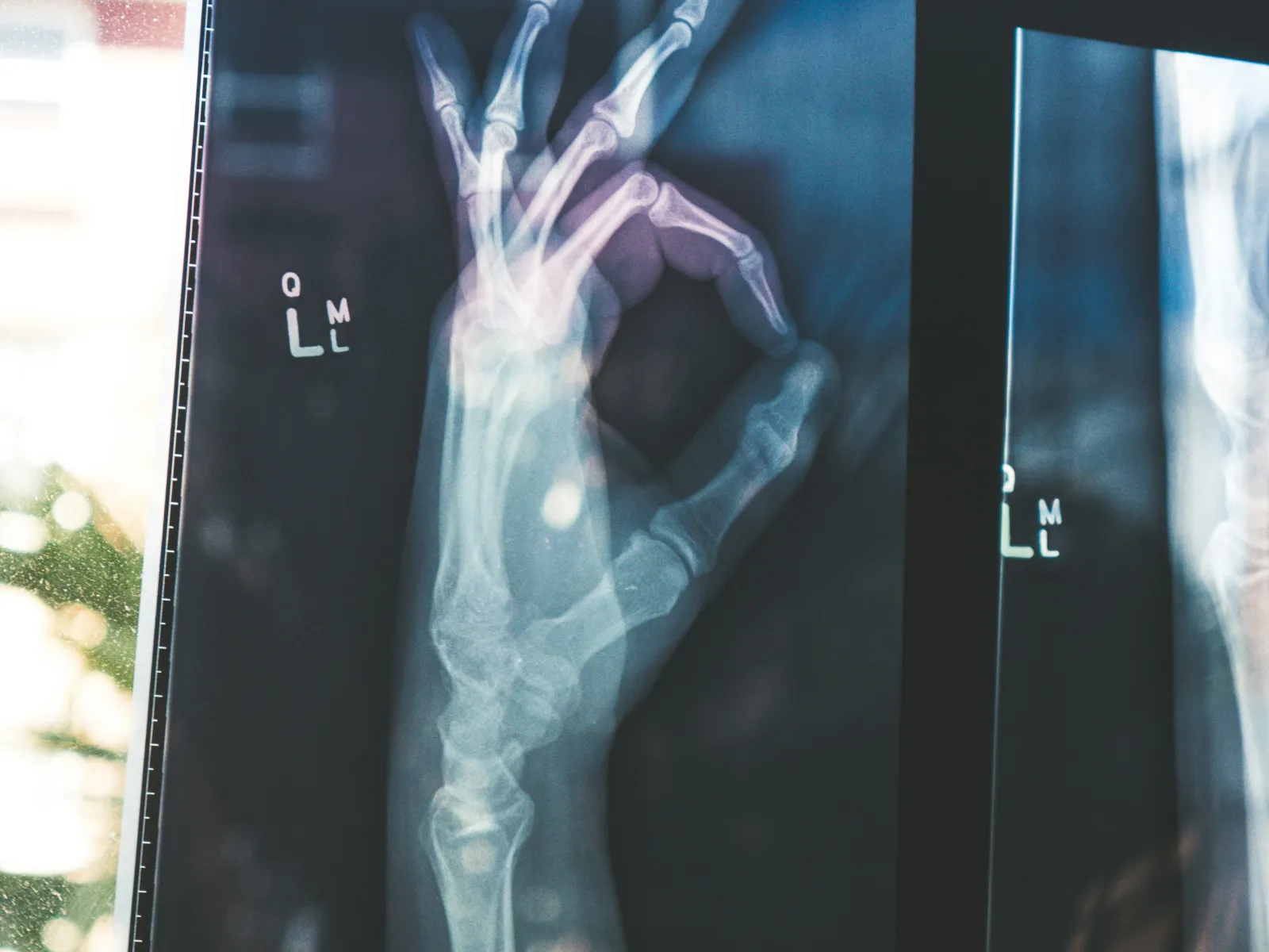 X-ray image showing a hand making an OK sign with visible bones and joints in radiology film.