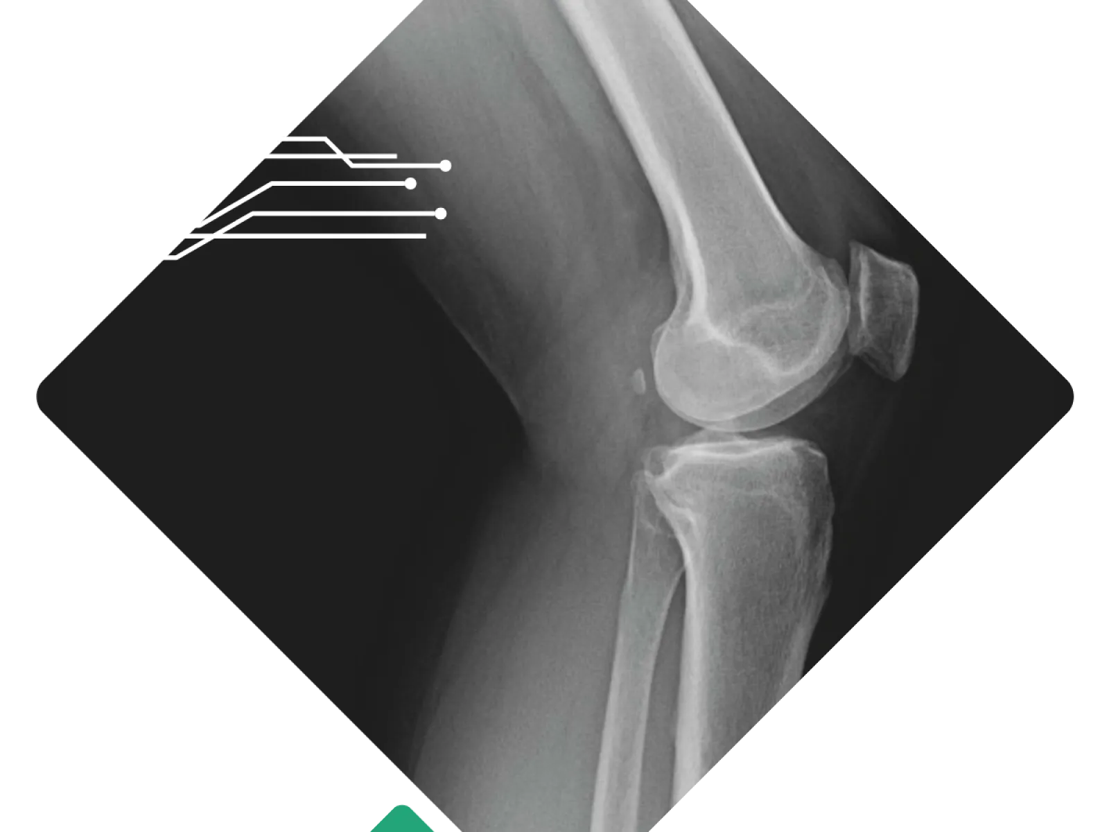 X-ray image showing a human knee joint with visible femur, tibia, and patella bones in a diamond frame.