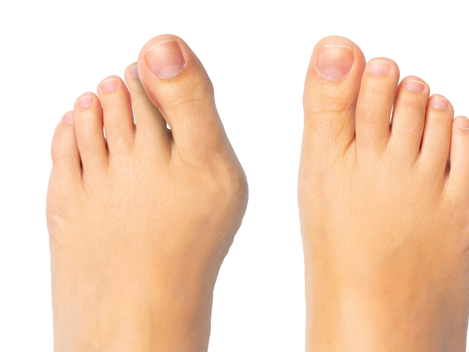 Close-up of human feet showing a bunion deformity on the left foot against a white background.
