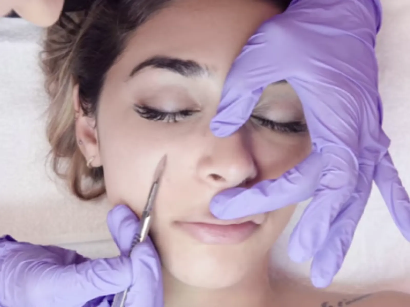 What is Dermaplaning?