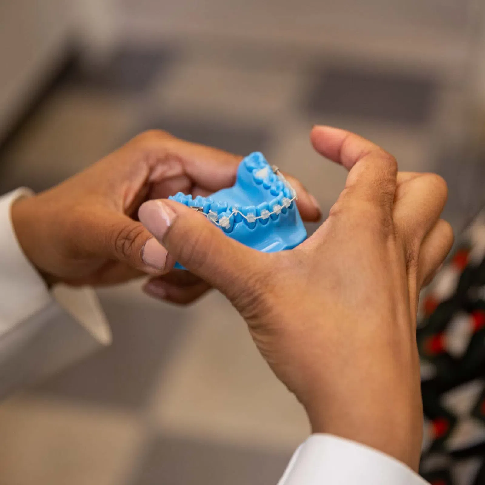 Hands holding a blue dental mold with braces, demonstrating orthodontic treatment details.