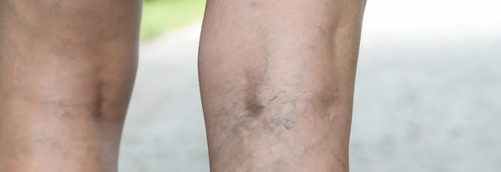 Onlyfans varicose veins inside the penis Porno gratuit
