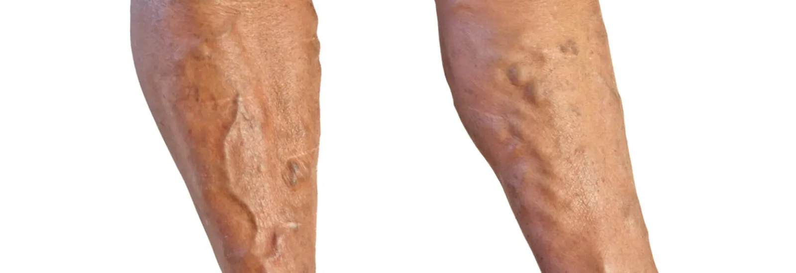 Varicose Vein Treatment - Heart and Vascular Wellness Center