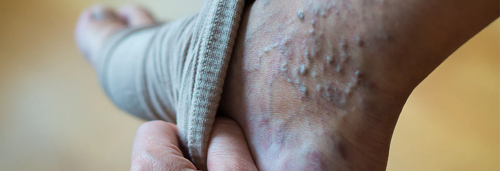 Varicose veins affecting the leg of an elderly man - Stock Image