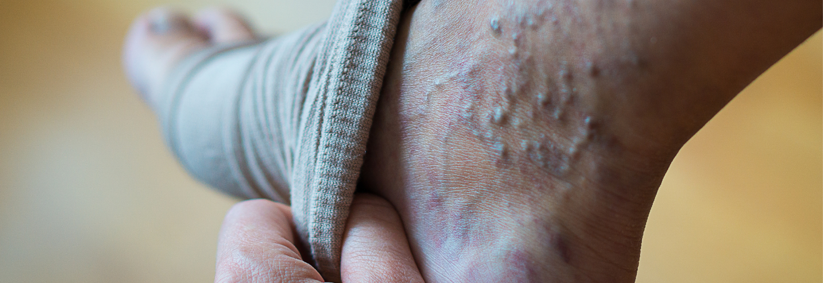 Spider Vein Symptoms You May Not Expect