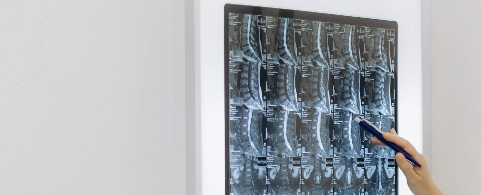 Doctor pointing at spinal X-ray images displayed on a lightbox in a medical office setting.