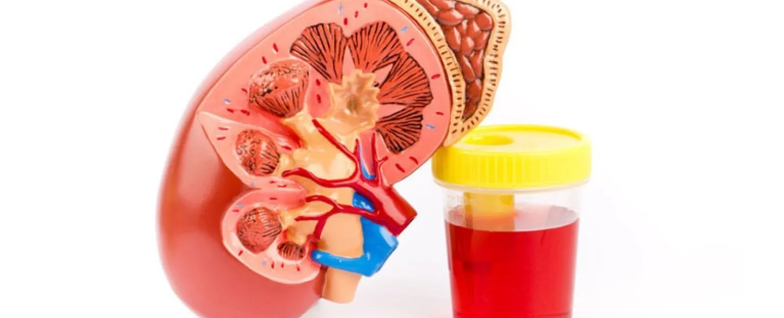 Hematuria (Blood in the Urine) 