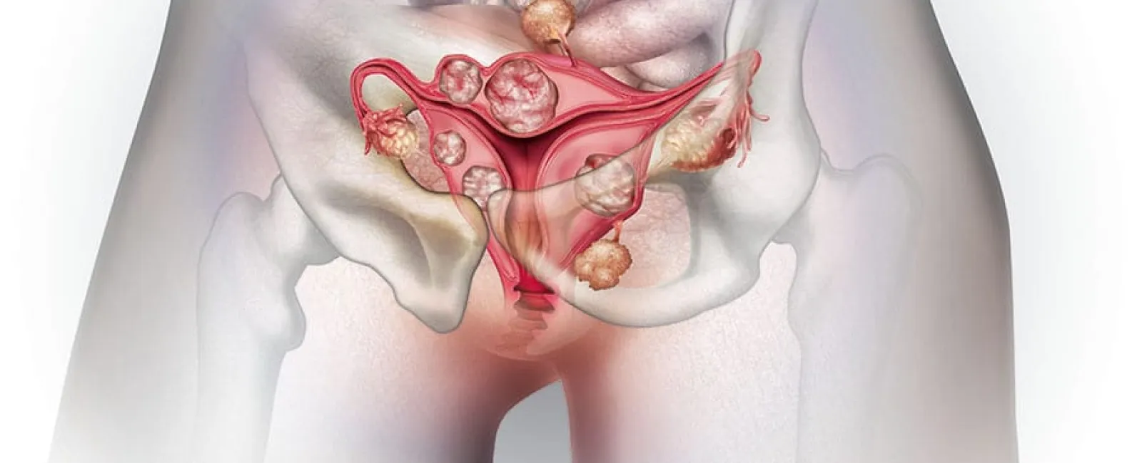 The Difference Between Ovarian Cysts and Fibroids