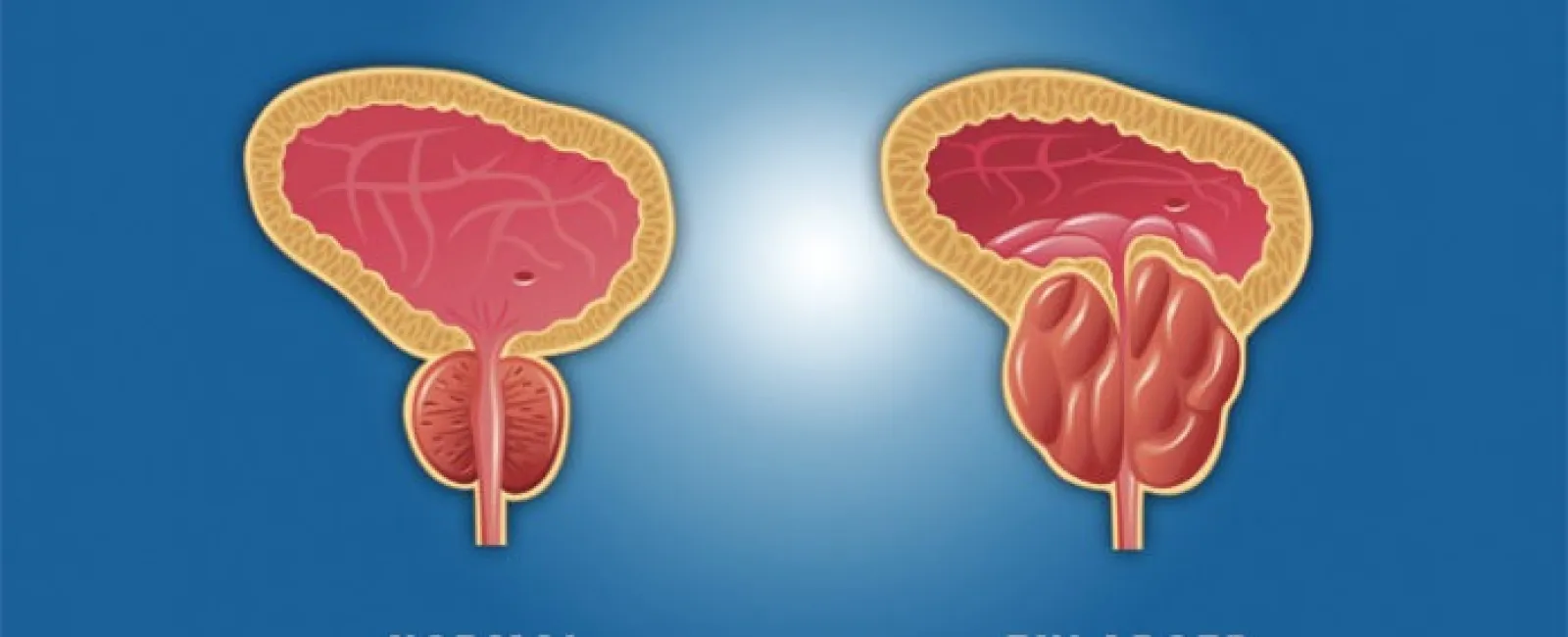 Elevated Prostate Specific Antigen (PSA) 