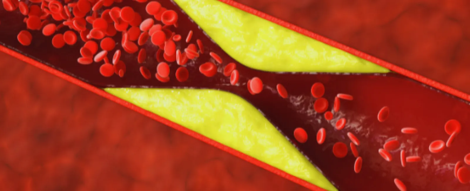 Cross-section of an artery showing yellow plaque buildup narrowing the blood vessel with red blood cells flowing through