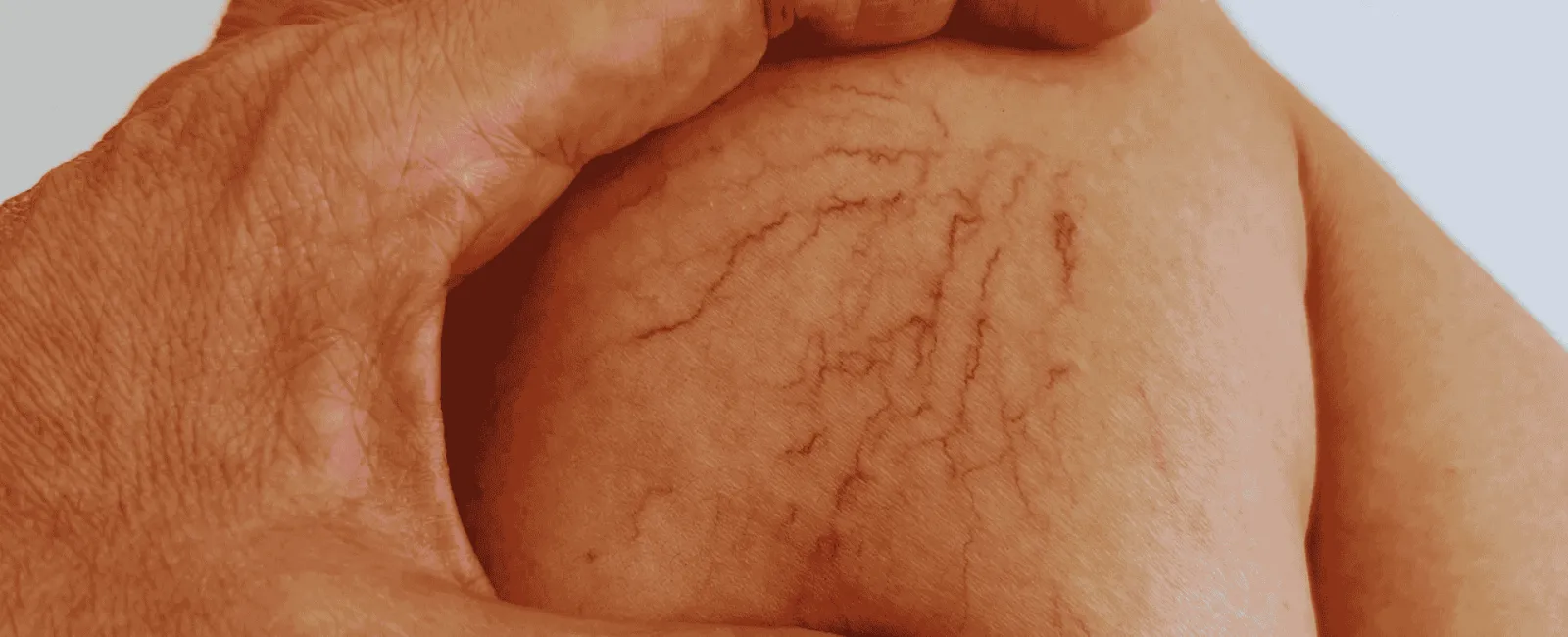 Close-up of skin with visible spider veins being gently touched by fingers against a light background