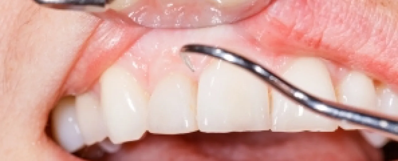 ORAL CANCER: RISK FACTORS, SCREENING, AND PREVENTION