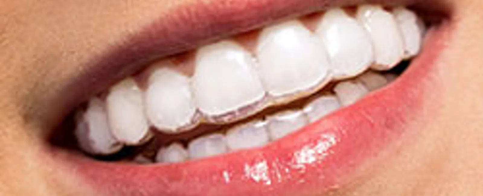 Is Invisalign Right For You?