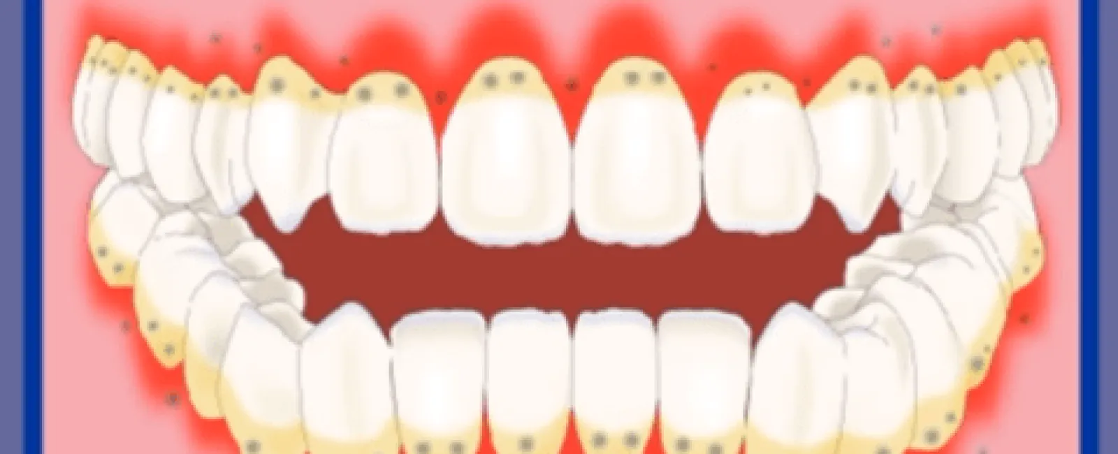 Illustration of unhealthy, inflamed gums surrounding bright white teeth highlighting dental health issues.