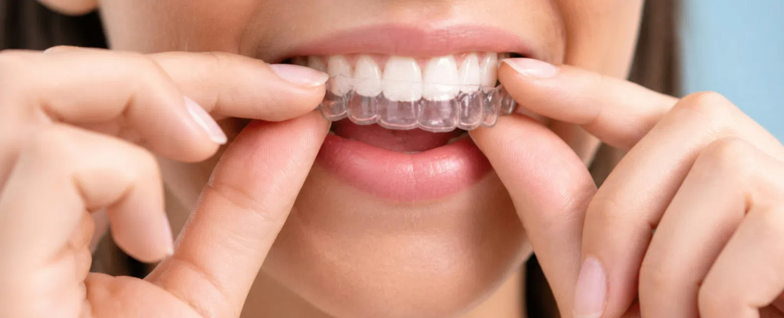 Tips for Caring for a Retainer or Night Guard Between Uses