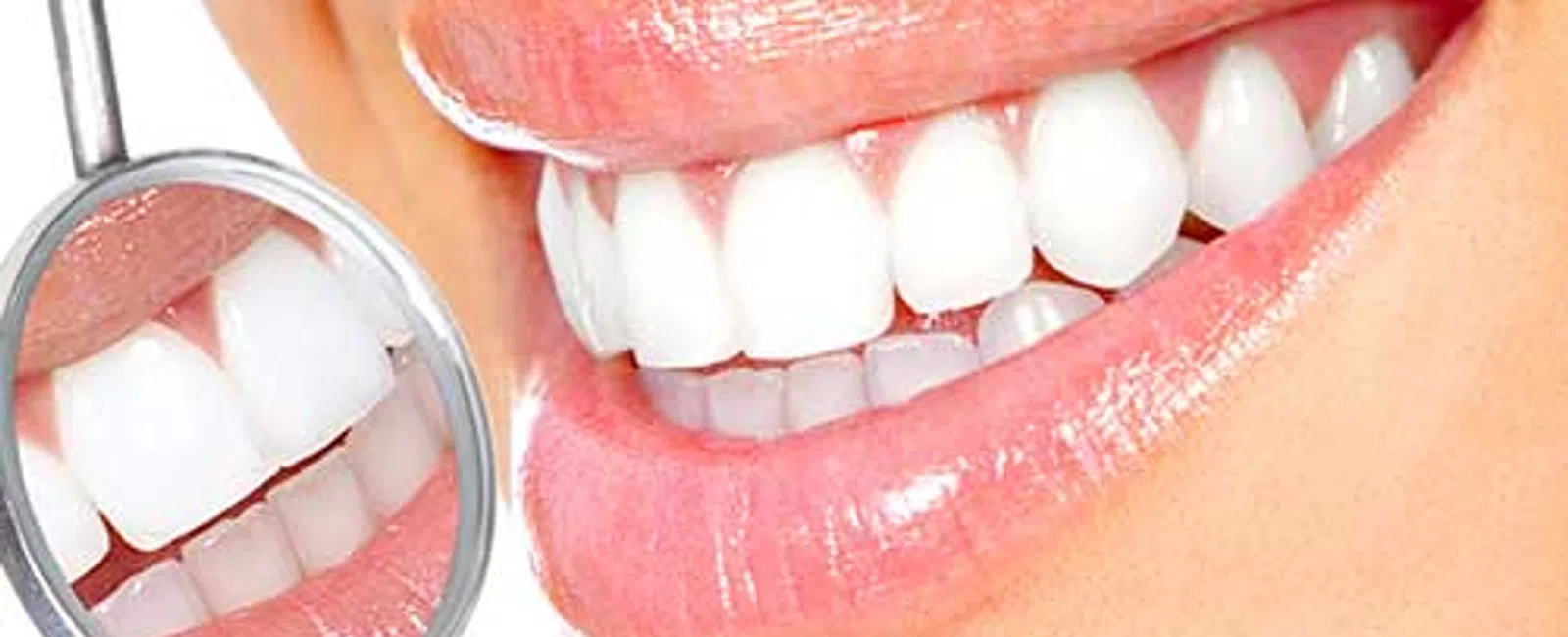 Ultra-Thin Veneers