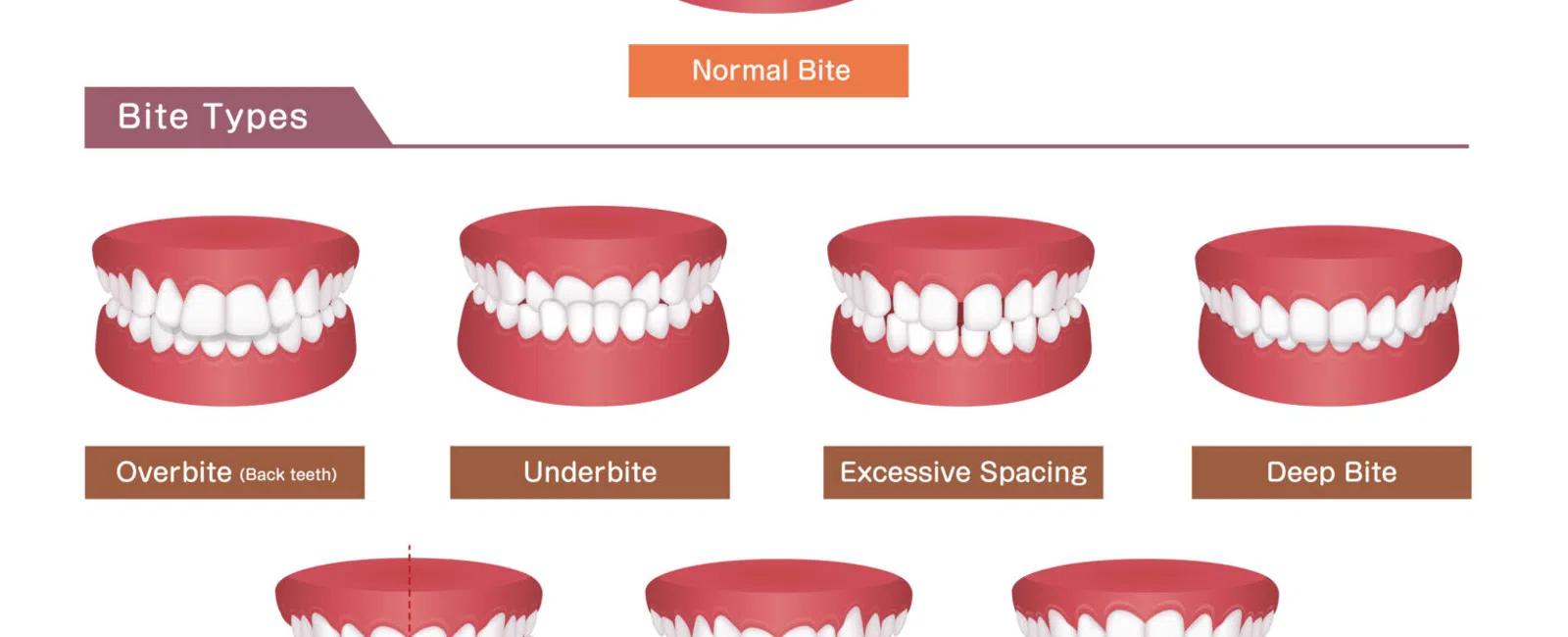 Diagram showing seven types of dental bites including normal, overbite, underbite, spacing, deep bite, crossbite, crowding, and open bite.