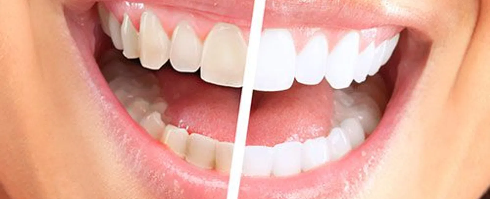 Turn Back Time This Fall With Professional Whitening [Blog]