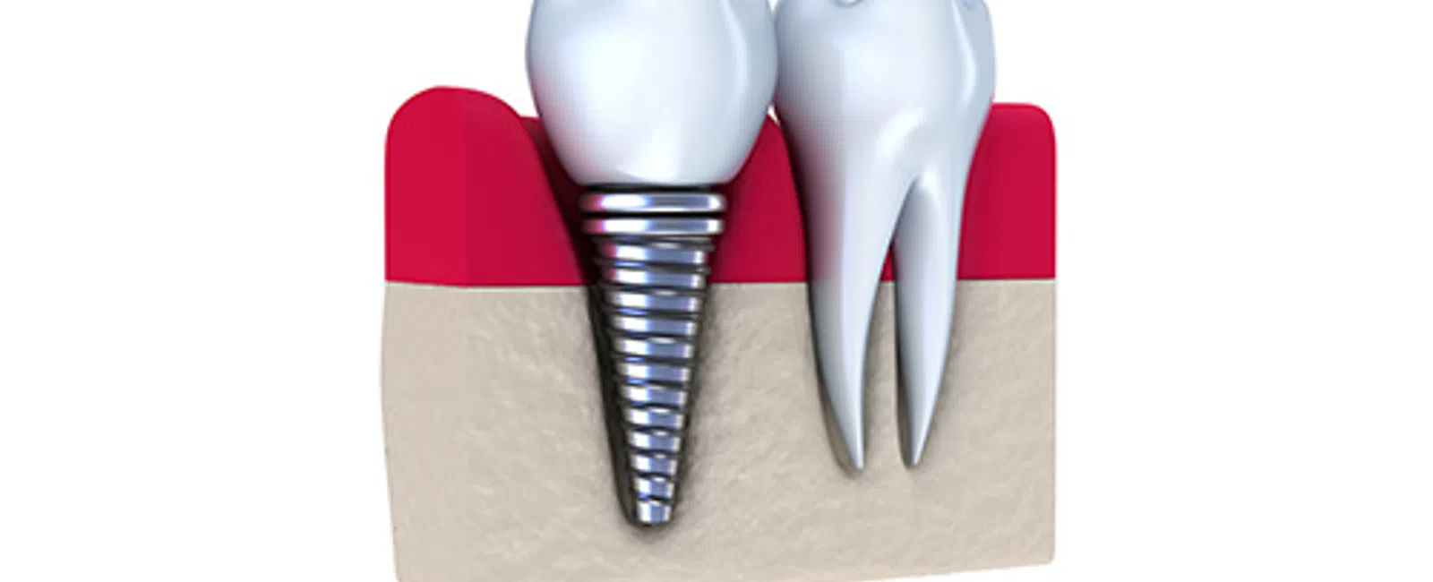 Dental Implants at Martins Dental Partners