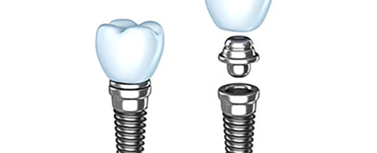 The Benefits of Dental Implants