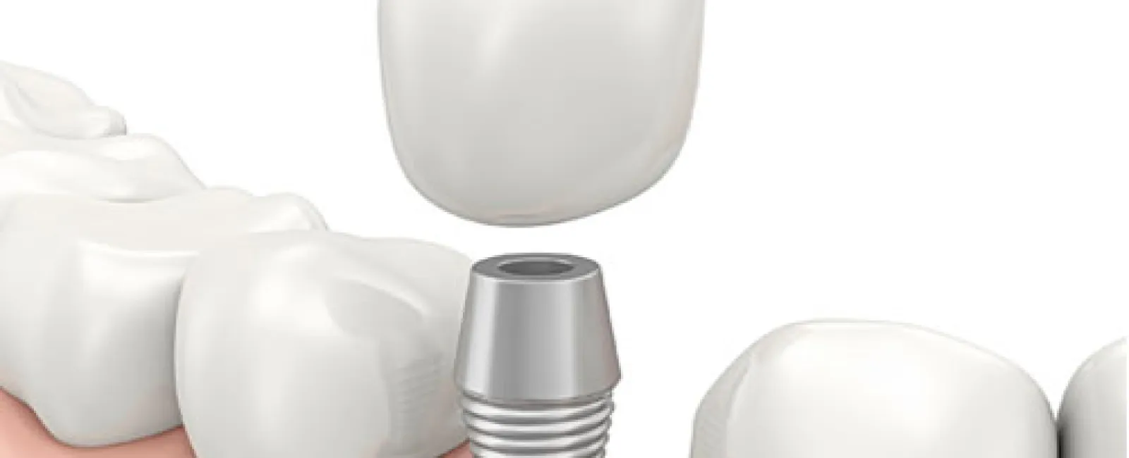 Three Benefits of Getting Dental Implants