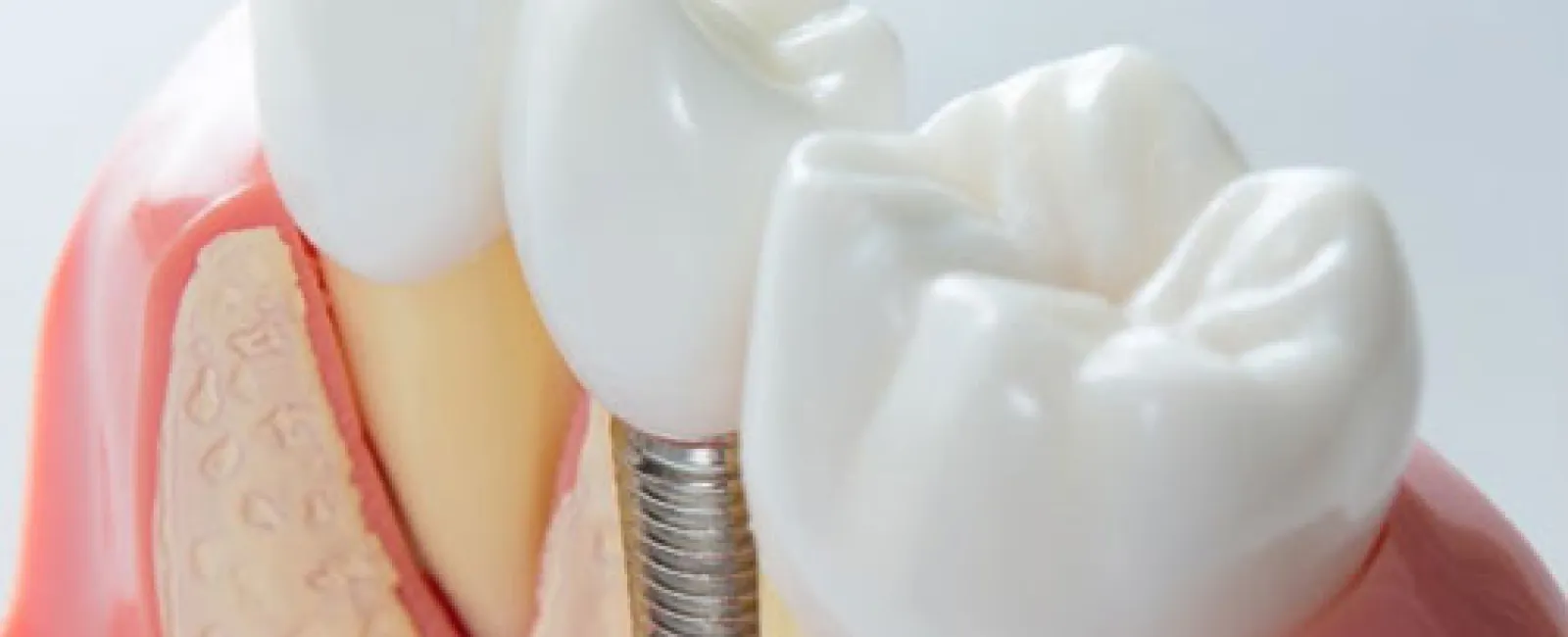 Missing Teeth? You Need to Know About Dental Implants
