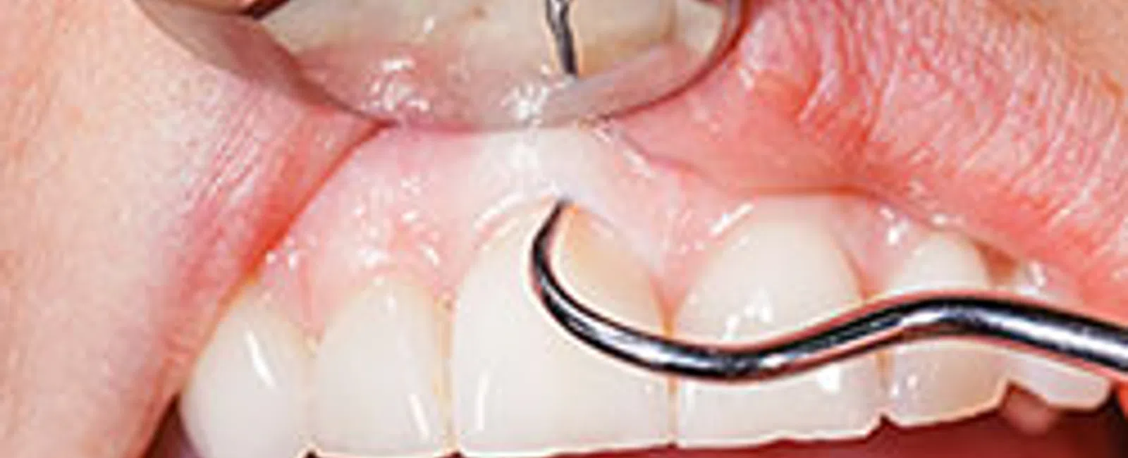 Don't Ignore These Signs Of Periodontal Disease