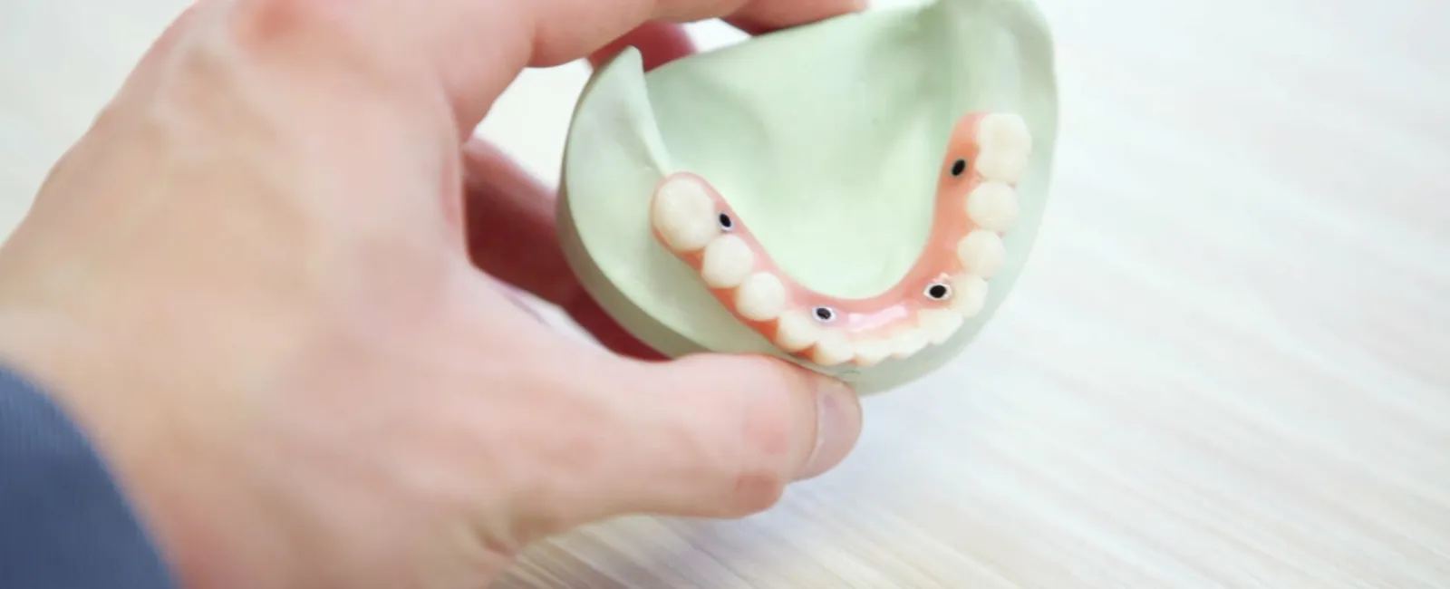 What are Dental Caps?