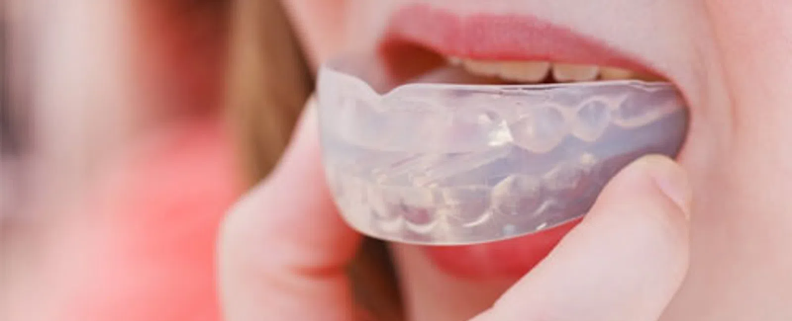 Close-up of a person inserting a clear dental night guard or mouthguard into their mouth for teeth protection.