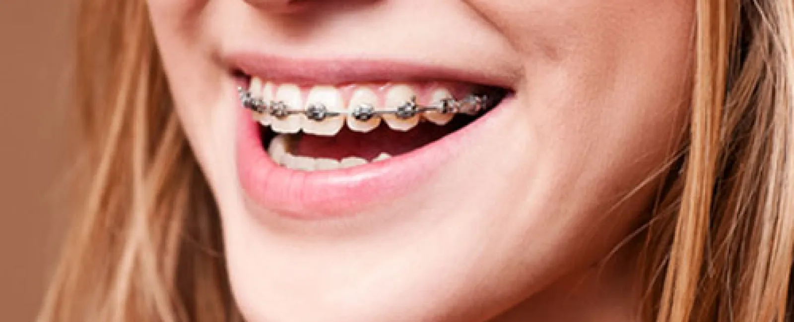 Straighten Your Teeth in As Quick as Six Months