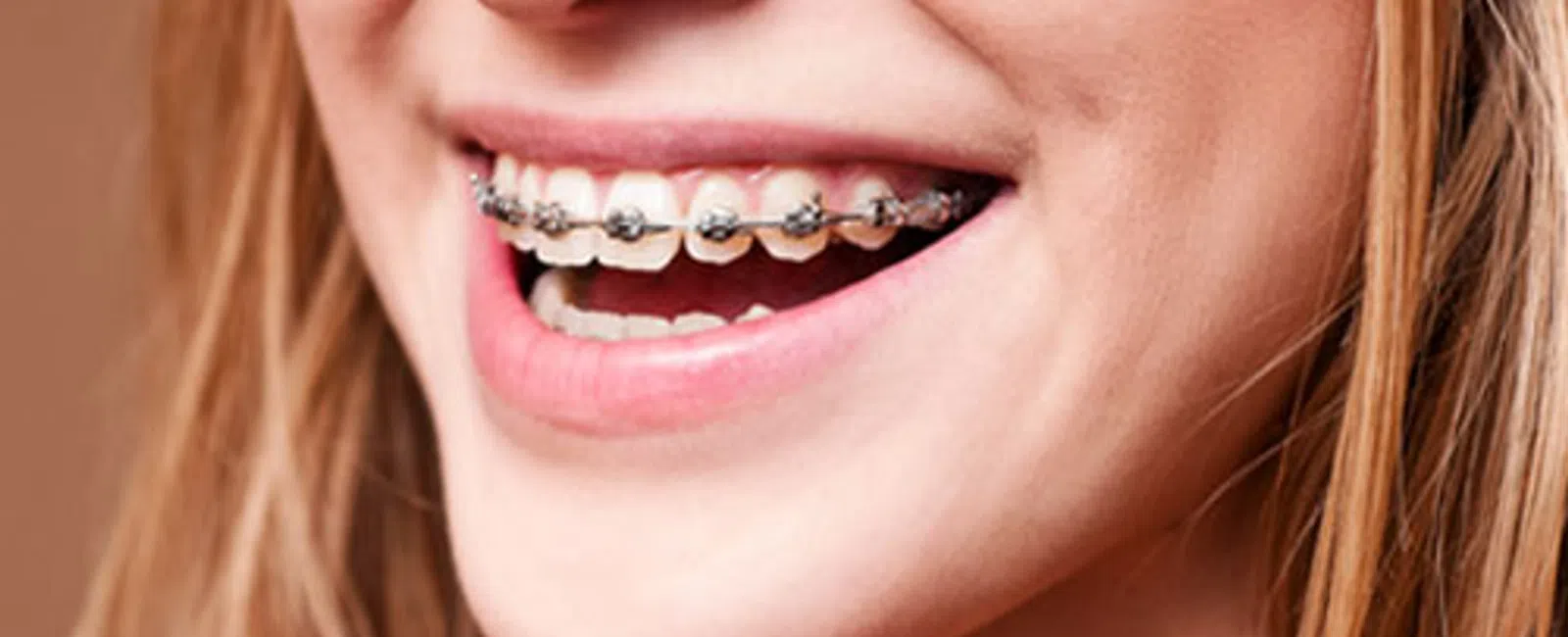Close-up of a smiling woman with metal braces on her teeth, showcasing dental orthodontic treatment.