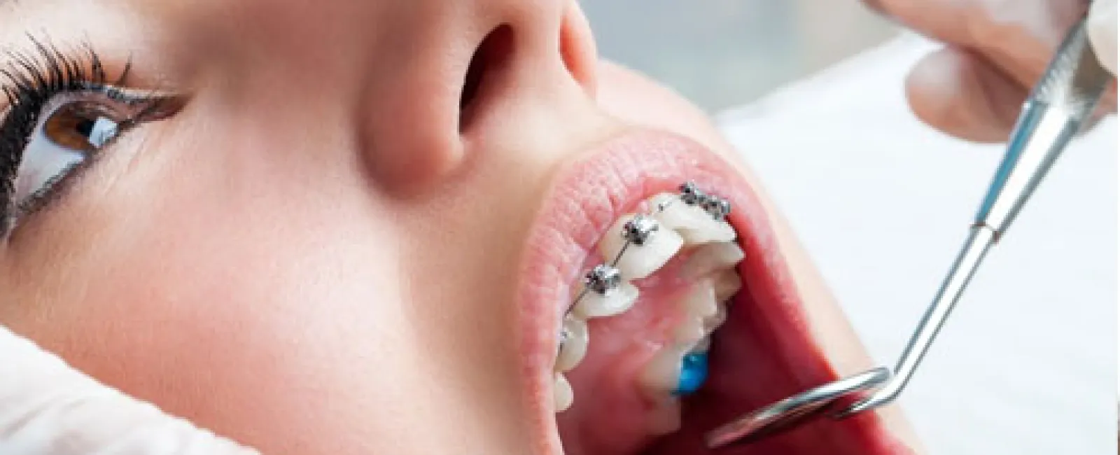 It’s the Right Season to Start Orthodontics