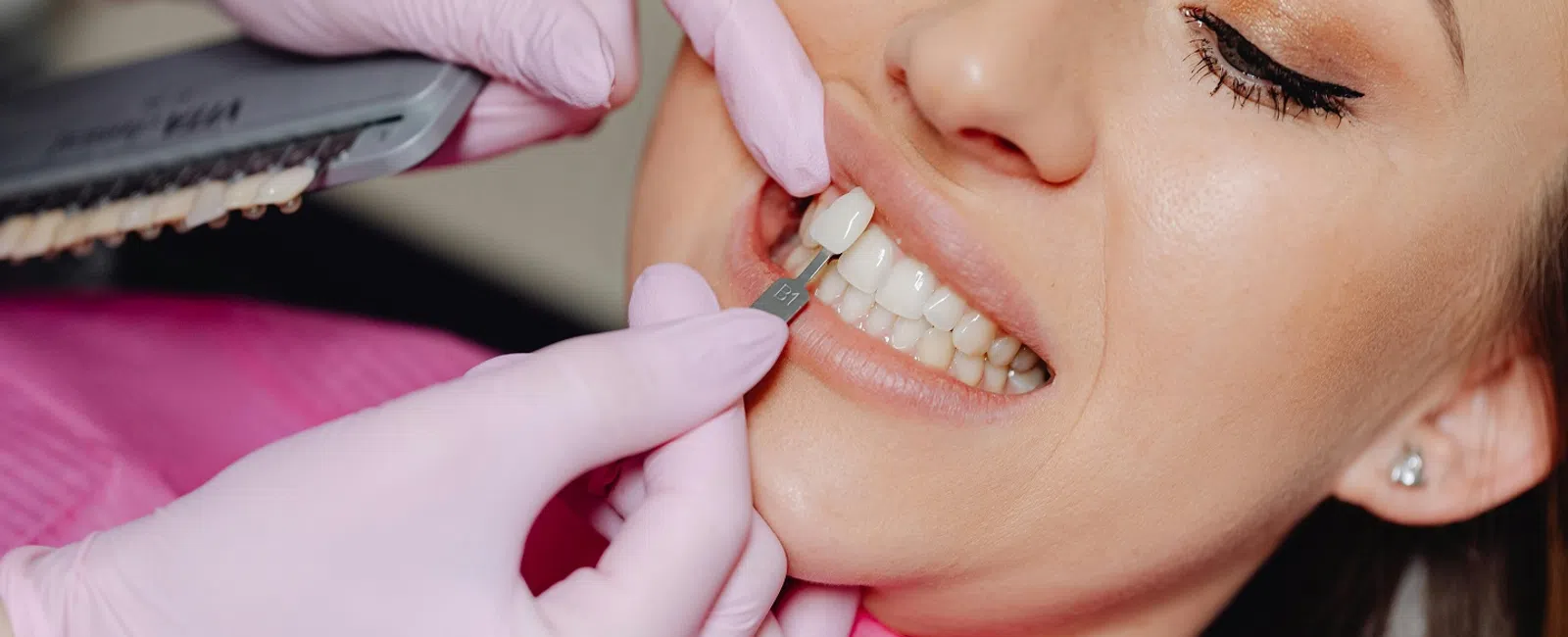 Dentist matching dental veneer shade to patient's teeth using a shade guide tool during consultation.
