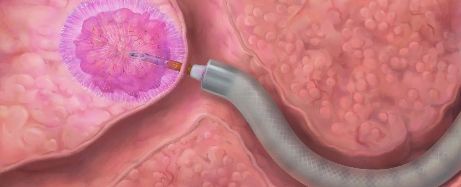 Medical illustration of pulsed electric field ablation using an endoscopic needle to target and destroy prostate cancer cells.