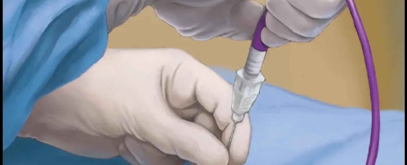 Pulsed Electrical Field (PEF) at Atlanta Prostate Center