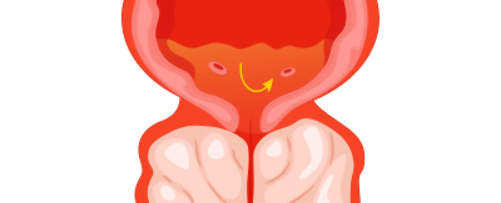 Illustration of an enlarged prostate compressing the urethra.