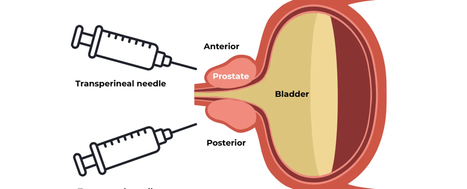 Diagram showing prostate and bladder anatomy with labeled transperineal and transrectal needle insertion points.