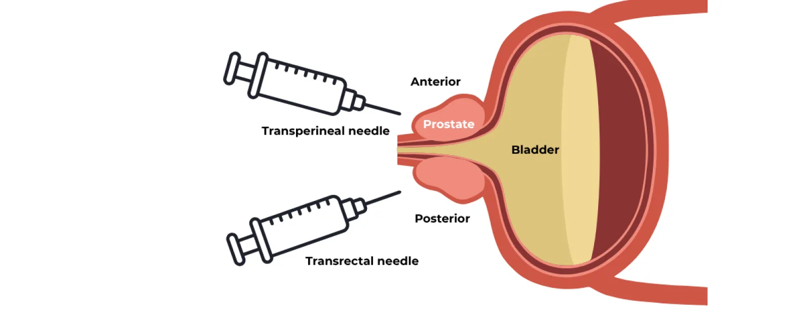 Diagram showing anterior transperineal and posterior transrectal needle approaches to the prostate and bladder.