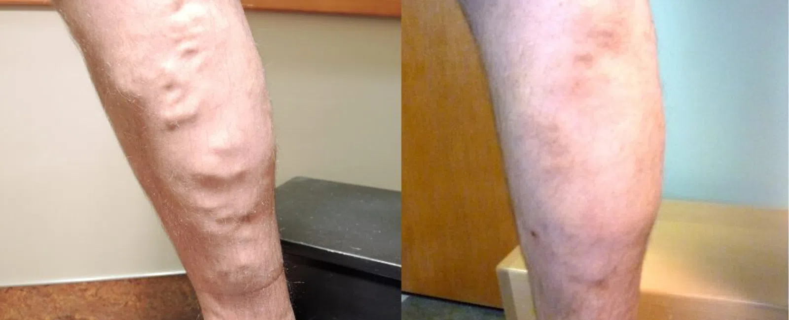 Best Treatment for Varicose Veins in Atlanta, GA: A Complete Guide