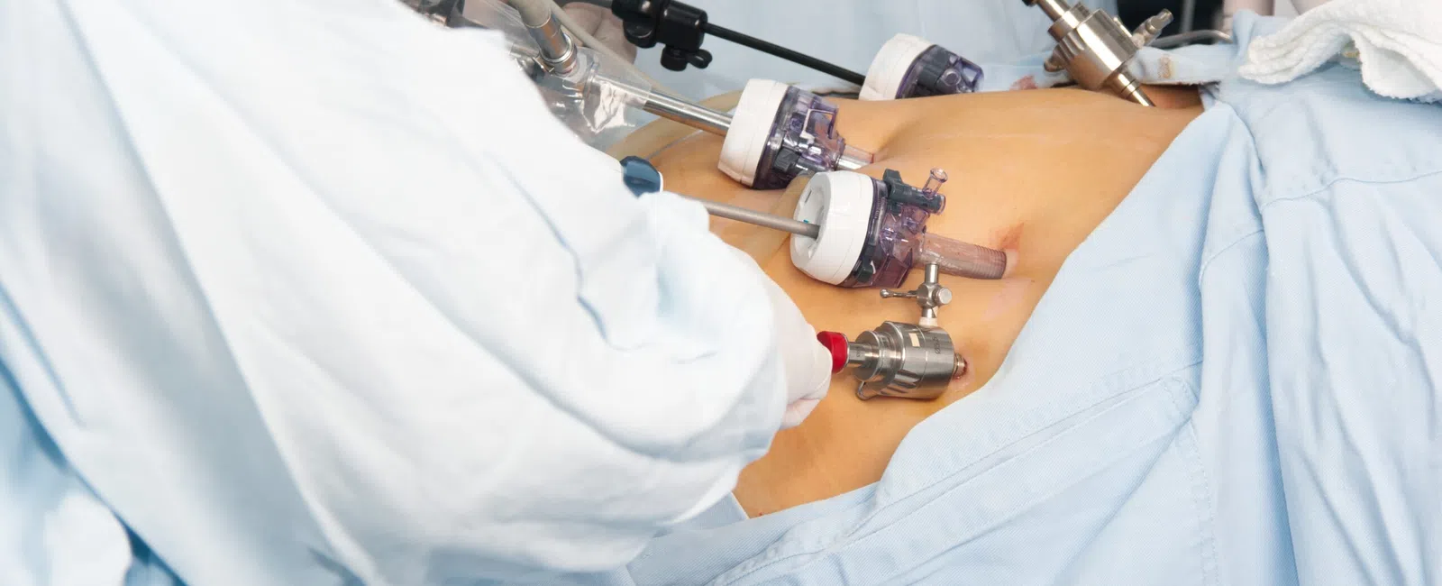 Gastric Bypass Surgery